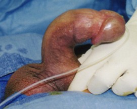 Plaque removal surgerybefore