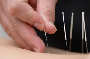 dnews-files-2013-02-accupuncture-660x433-130222-picture-jpg